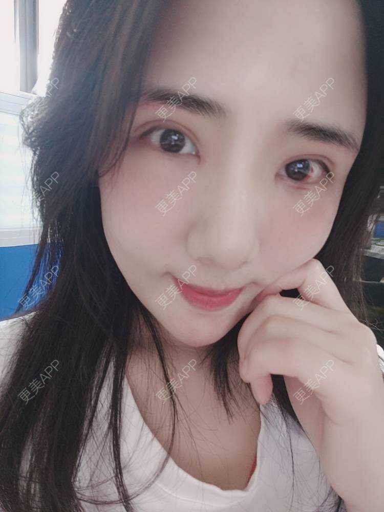 更美 - 更美用户R2vuT1w108的双眼皮修复经验 | 广州 | 双眼皮修复