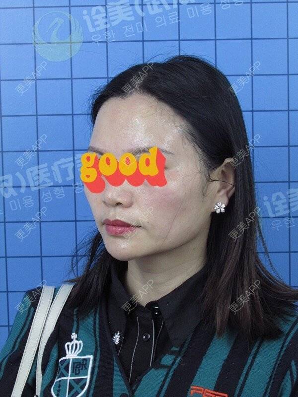 更美 - 柔情全是误会的拉皮经验 | 拉皮 | 武汉