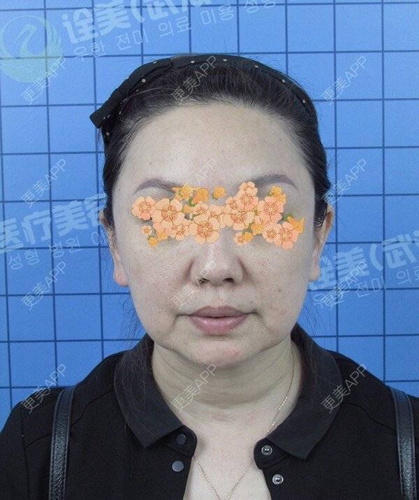 更美 - 字不醉人人自醉木的拉皮经验 | 武汉 | 拉皮