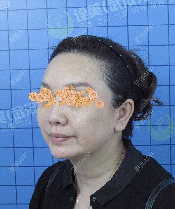 更美 - 字不醉人人自醉木的拉皮经验 | 武汉 | 拉皮