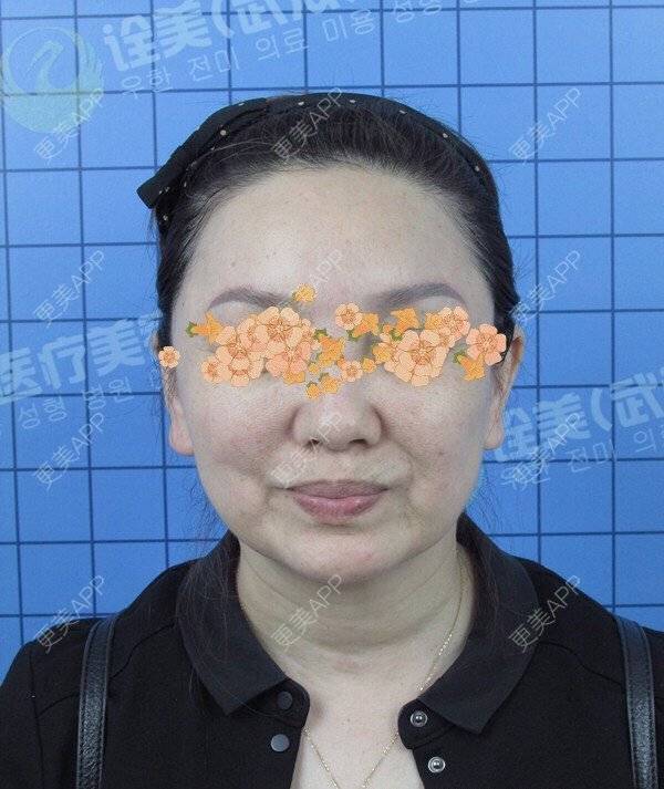 更美 - 字不醉人人自醉木的拉皮经验 | 武汉 | 拉皮