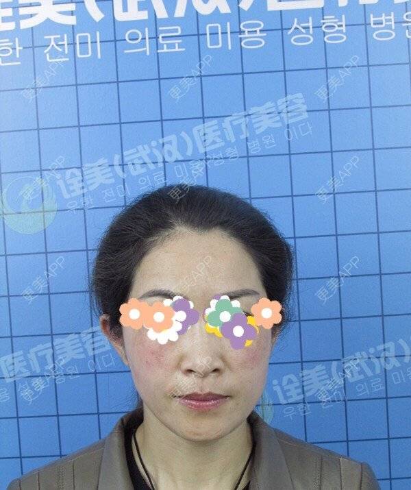 更美 - 52000006的拉皮经验 | 拉皮 | 武汉