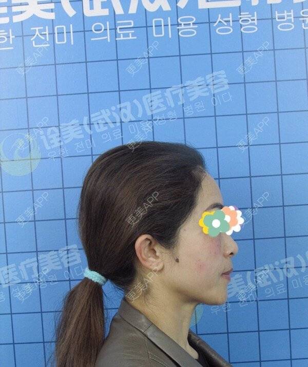 更美 - 52000006的拉皮经验 | 拉皮 | 武汉