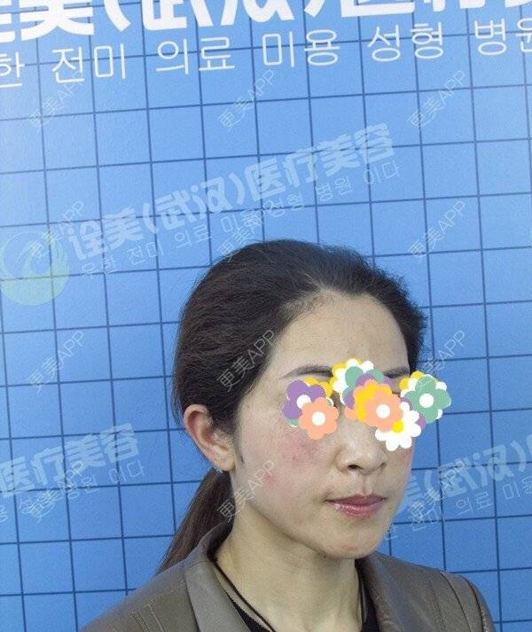 更美 - 52000006的拉皮经验 | 拉皮 | 武汉