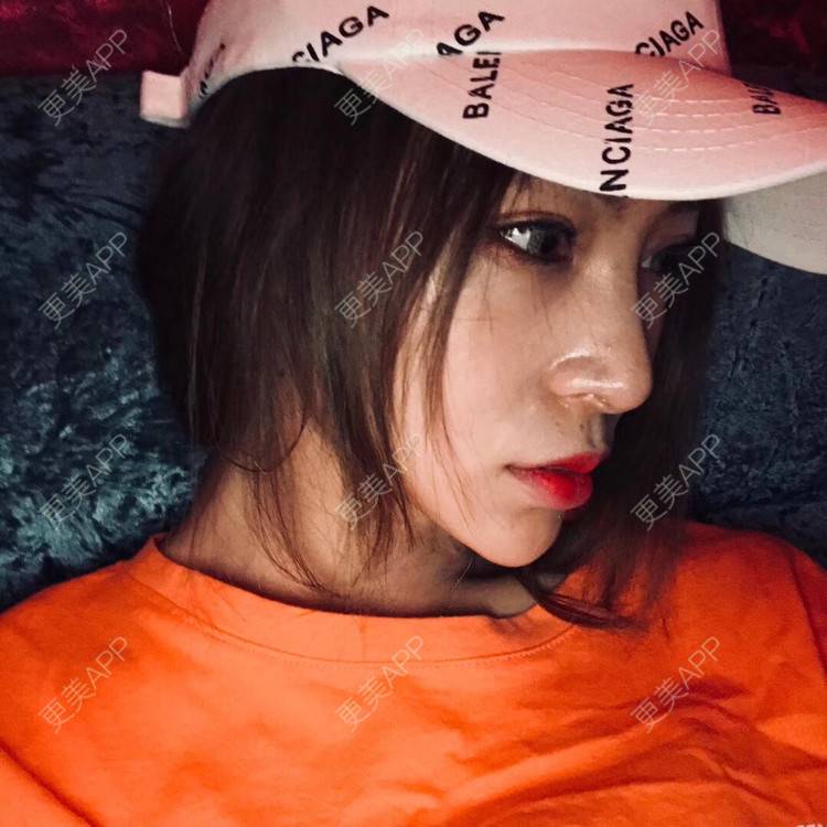 更美 - 更美用户rjPyXjXE2z的硅胶丰太阳穴经验 | 郑州 | 硅胶丰太阳穴 | 视频日记