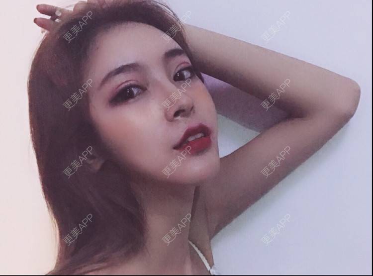 更美 - 更美用户rjPyXjXE2z的硅胶丰太阳穴经验 | 郑州 | 硅胶丰太阳穴 | 视频日记