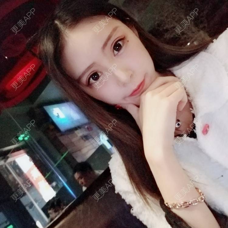 更美 - 更美用户rjPyXjXE2z的硅胶丰太阳穴经验 | 郑州 | 硅胶丰太阳穴 | 视频日记