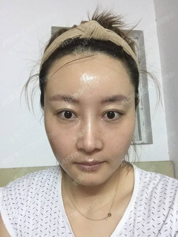 更美 - 坤坤love的肋软骨隆鼻经验 | 肋软骨隆鼻 | 胶原蛋白隆鼻 | 鼻中隔软骨隆鼻 | 耳软骨隆鼻 | 武汉
