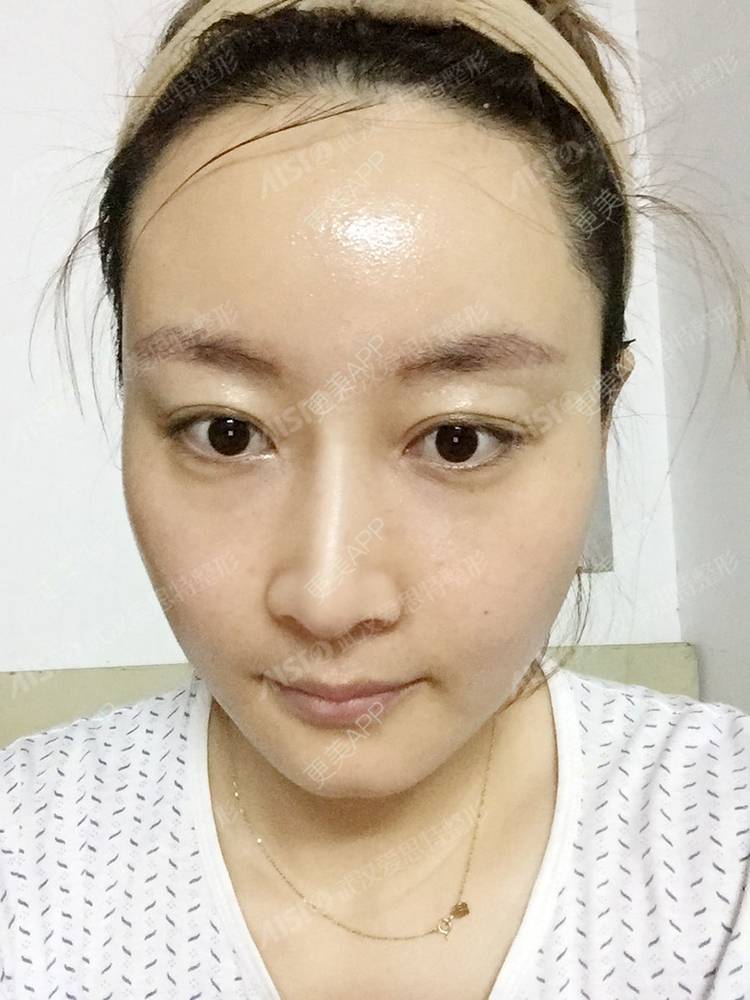 更美 - 坤坤love的肋软骨隆鼻经验 | 肋软骨隆鼻 | 胶原蛋白隆鼻 | 鼻中隔软骨隆鼻 | 耳软骨隆鼻 | 武汉