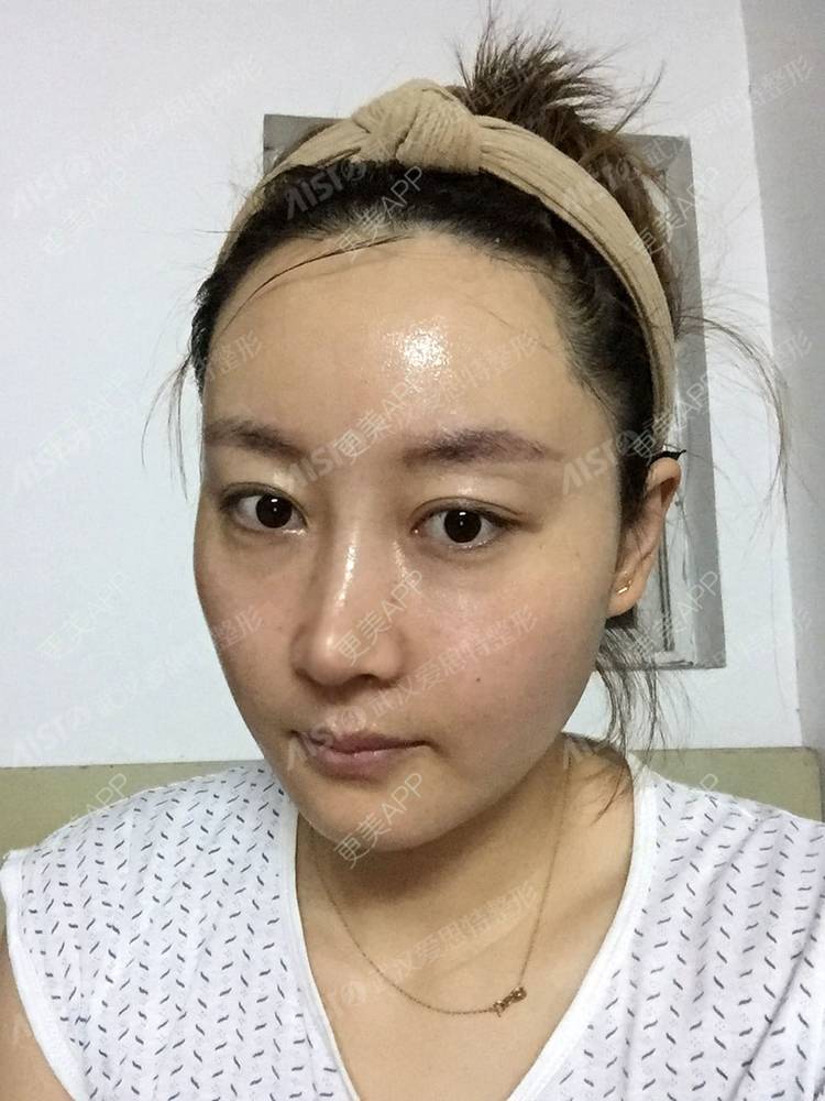 更美 - 坤坤love的肋软骨隆鼻经验 | 肋软骨隆鼻 | 胶原蛋白隆鼻 | 鼻中隔软骨隆鼻 | 耳软骨隆鼻 | 武汉