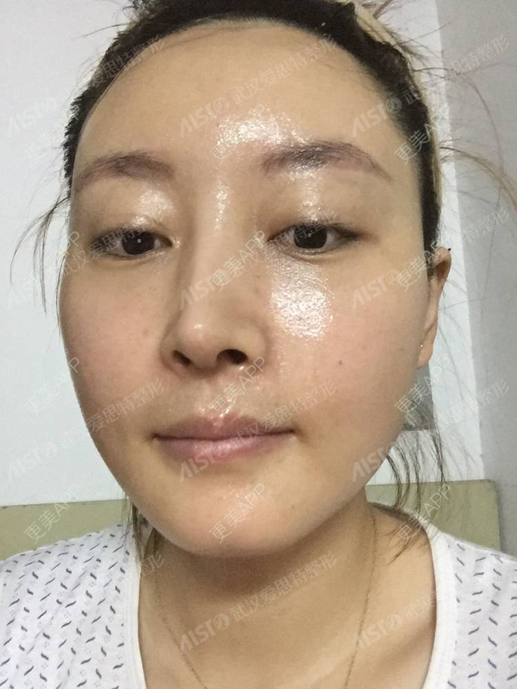 更美 - 坤坤love的肋软骨隆鼻经验 | 肋软骨隆鼻 | 胶原蛋白隆鼻 | 鼻中隔软骨隆鼻 | 耳软骨隆鼻 | 武汉