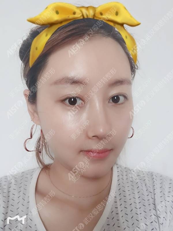 更美 - 坤坤love的肋软骨隆鼻经验 | 肋软骨隆鼻 | 胶原蛋白隆鼻 | 鼻中隔软骨隆鼻 | 耳软骨隆鼻 | 武汉