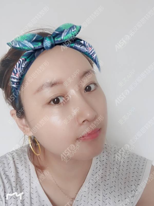 更美 - 坤坤love的肋软骨隆鼻经验 | 肋软骨隆鼻 | 胶原蛋白隆鼻 | 鼻中隔软骨隆鼻 | 耳软骨隆鼻 | 武汉