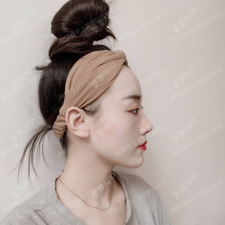 更美 - 肖肖ok的驼峰鼻矫正经验 | 驼峰鼻矫正 | 肋软骨隆鼻 | 胶原蛋白隆鼻 | 鼻中隔软骨隆鼻 | 耳软骨隆鼻 | 武汉