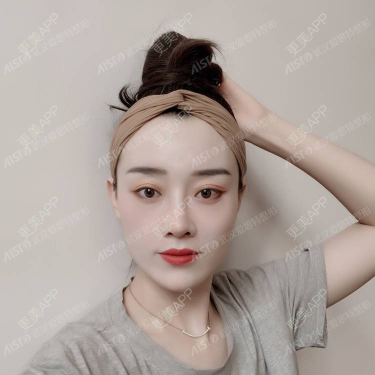 更美 - 肖肖ok的驼峰鼻矫正经验 | 驼峰鼻矫正 | 肋软骨隆鼻 | 胶原蛋白隆鼻 | 鼻中隔软骨隆鼻 | 耳软骨隆鼻 | 武汉