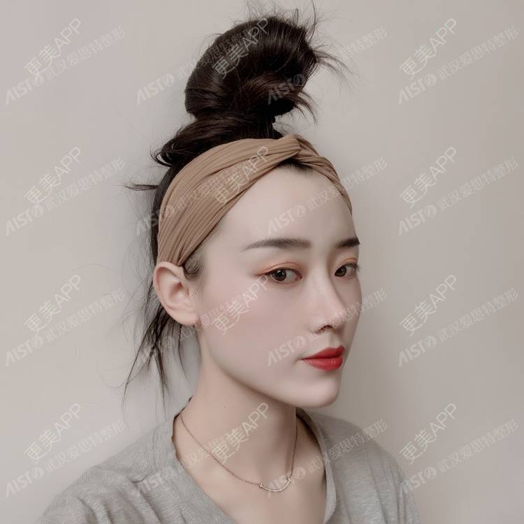 更美 - 肖肖ok的驼峰鼻矫正经验 | 驼峰鼻矫正 | 肋软骨隆鼻 | 胶原蛋白隆鼻 | 鼻中隔软骨隆鼻 | 耳软骨隆鼻 | 武汉