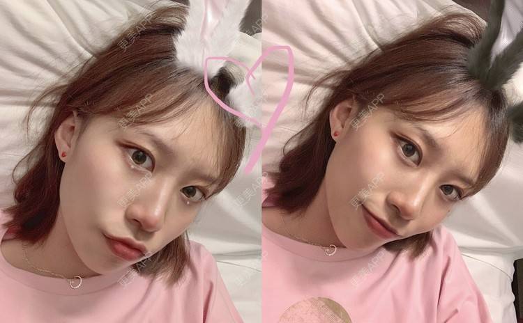 更美 - 本宫语的手术去副乳经验 | 手术去副乳 | 上海