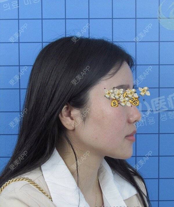 更美 - 谁要变好看的硅胶丰额头经验 | 硅胶丰额头