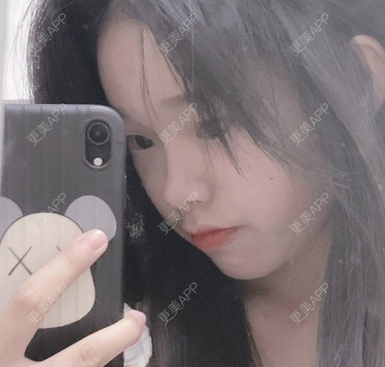 更美 - 寂静的时间的乳头内陷矫正经验 | 乳头内陷矫正 | 上海