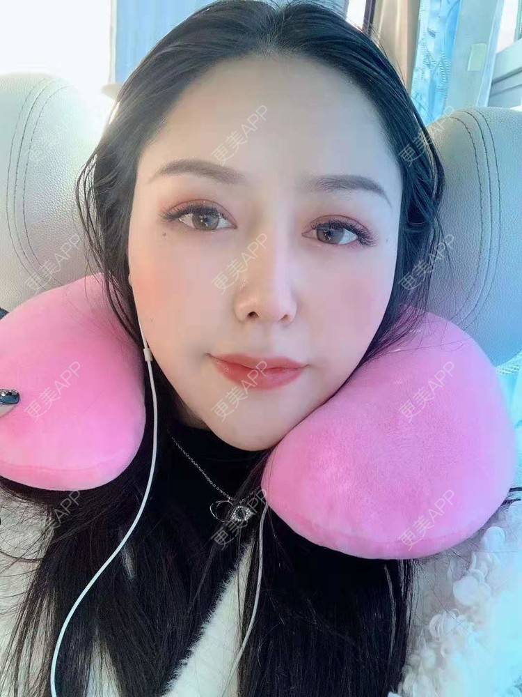 更美 - 更美用户dapPewZ45A的自体脂肪丰额头经验 | 自体脂肪丰额头 | 重庆