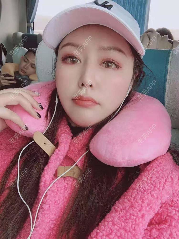 更美 - 更美用户dapPewZ45A的自体脂肪丰额头经验 | 自体脂肪丰额头 | 重庆