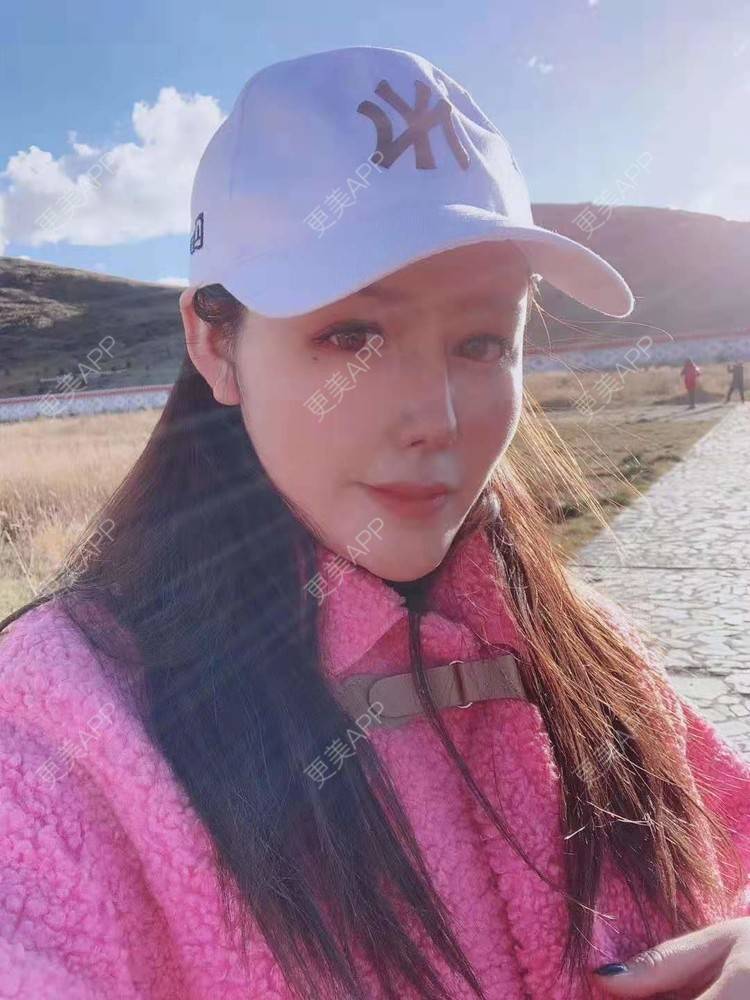 更美 - 更美用户dapPewZ45A的自体脂肪丰额头经验 | 自体脂肪丰额头 | 重庆