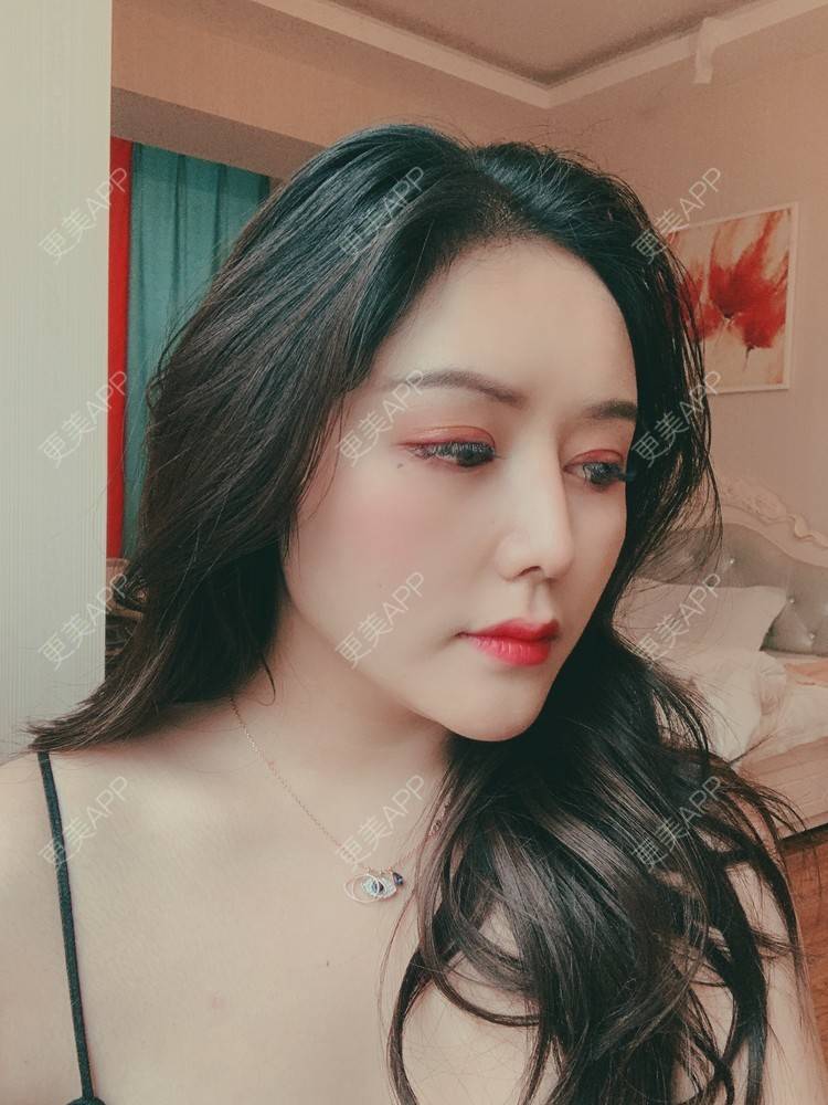 更美 - 更美用户dapPewZ45A的自体脂肪丰额头经验 | 自体脂肪丰额头 | 重庆