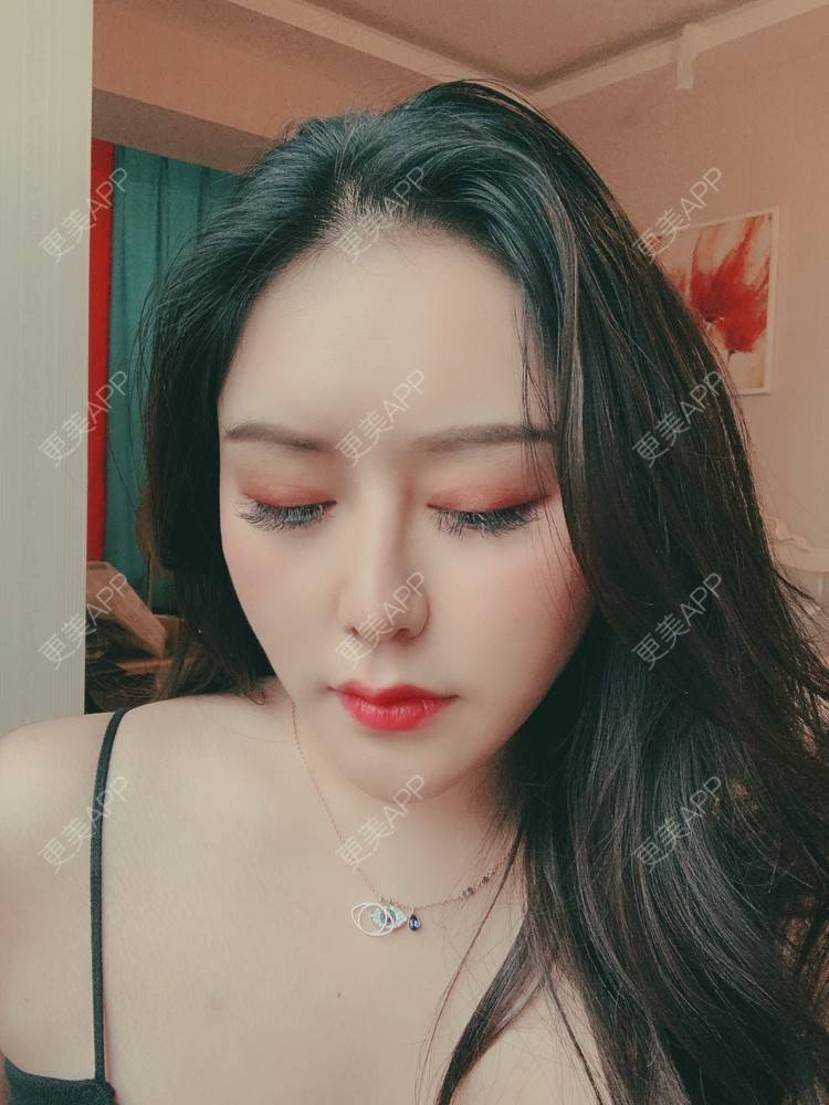 更美 - 更美用户dapPewZ45A的自体脂肪丰额头经验 | 自体脂肪丰额头 | 重庆