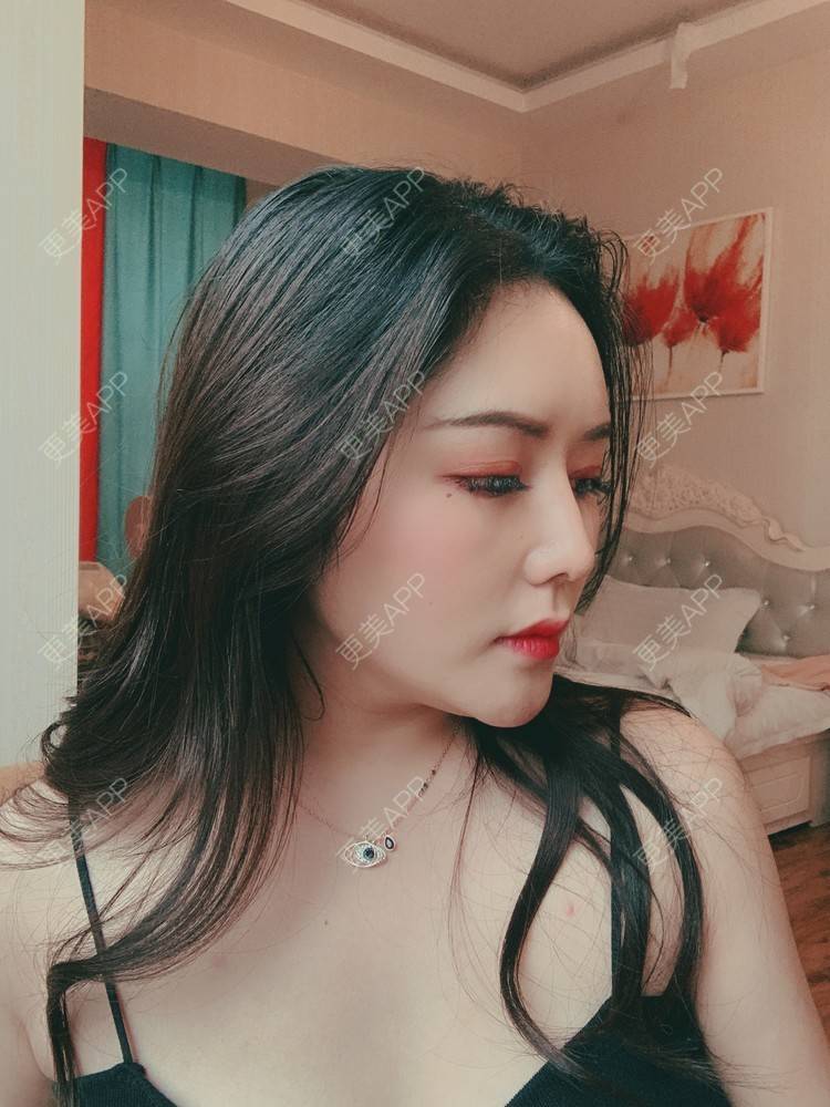 更美 - 更美用户dapPewZ45A的自体脂肪丰额头经验 | 自体脂肪丰额头 | 重庆