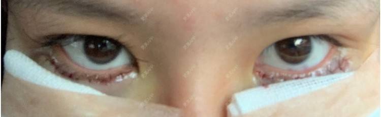 更美 - 更美用户JRW18yRt3p的真皮丰卧蚕经验 | 郑州 | 真皮丰卧蚕