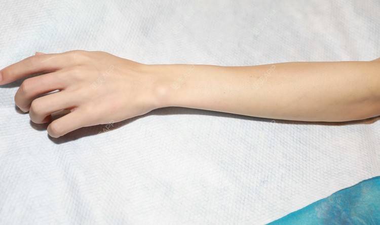 过程就是先把手臂的毛剃掉,然后涂上凝胶,然后再用仪器治疗,有一点点