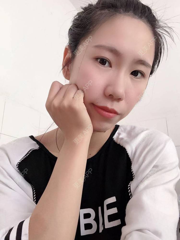 更美 - 更美用户IYey88gB48的硅胶丰太阳穴经验 | 硅胶丰太阳穴 | 膨体丰太阳穴 | 太阳穴 | 武汉