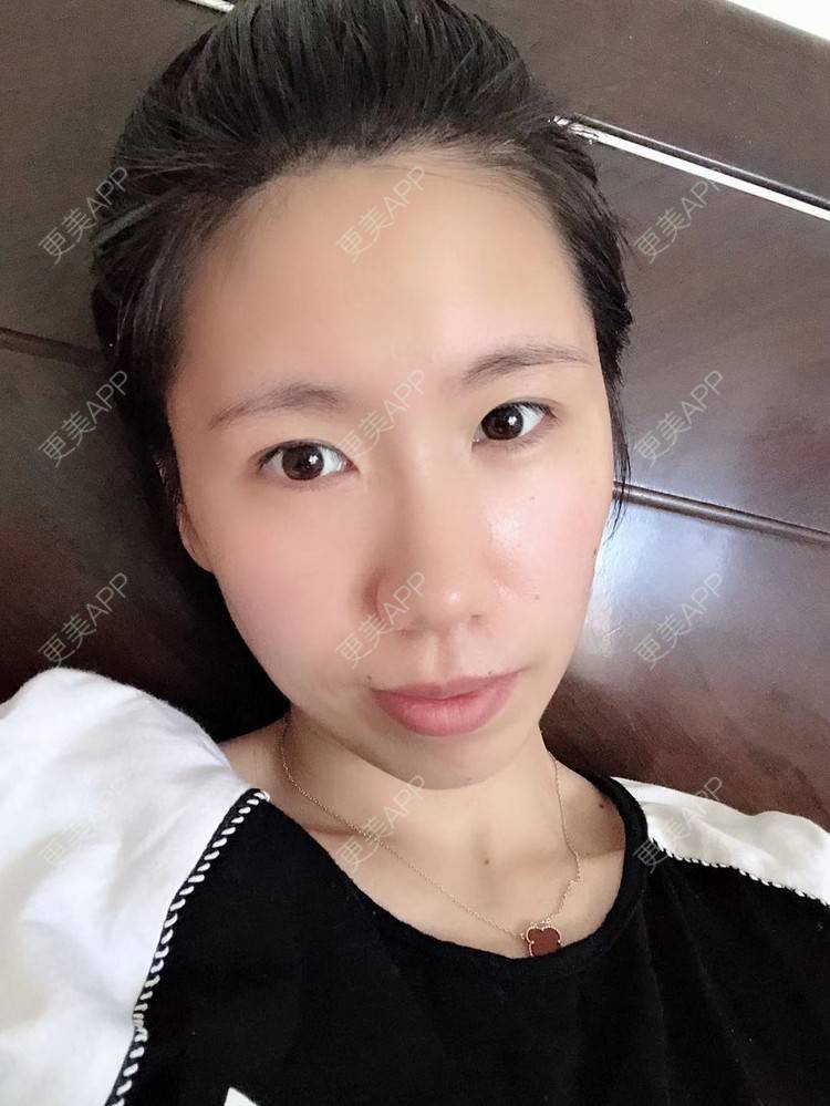 更美 - 更美用户IYey88gB48的硅胶丰太阳穴经验 | 硅胶丰太阳穴 | 膨体丰太阳穴 | 太阳穴 | 武汉