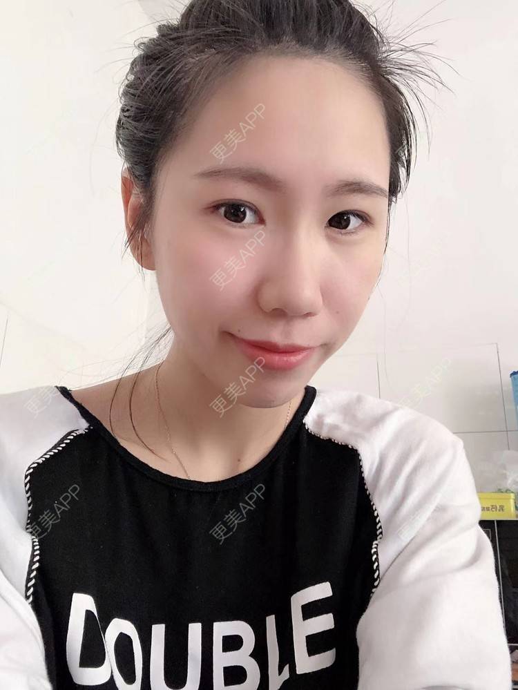 更美 - 更美用户IYey88gB48的硅胶丰太阳穴经验 | 硅胶丰太阳穴 | 膨体丰太阳穴 | 太阳穴 | 武汉