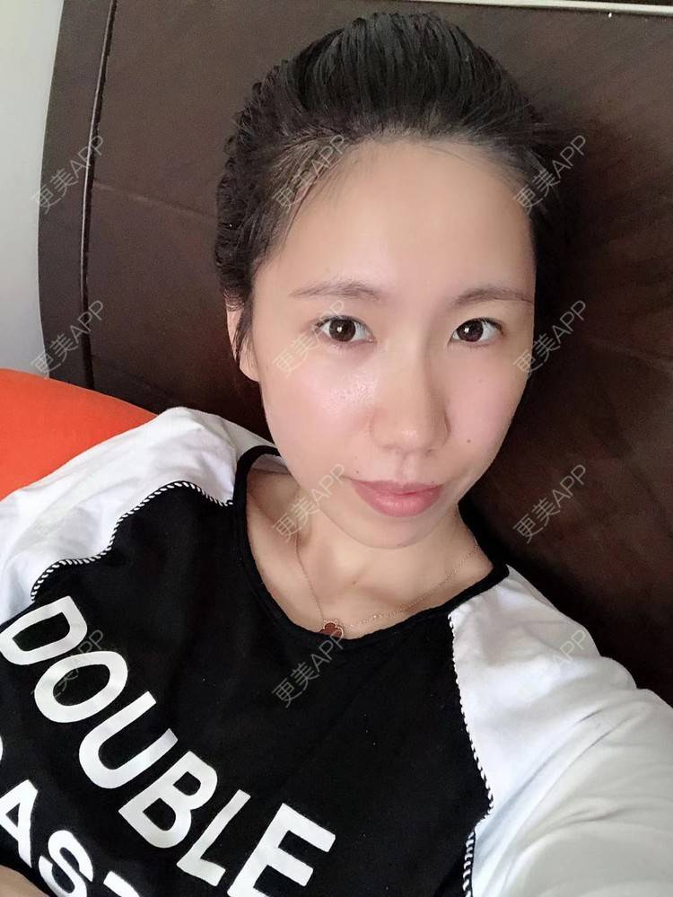 更美 - 更美用户IYey88gB48的硅胶丰太阳穴经验 | 硅胶丰太阳穴 | 膨体丰太阳穴 | 太阳穴 | 武汉