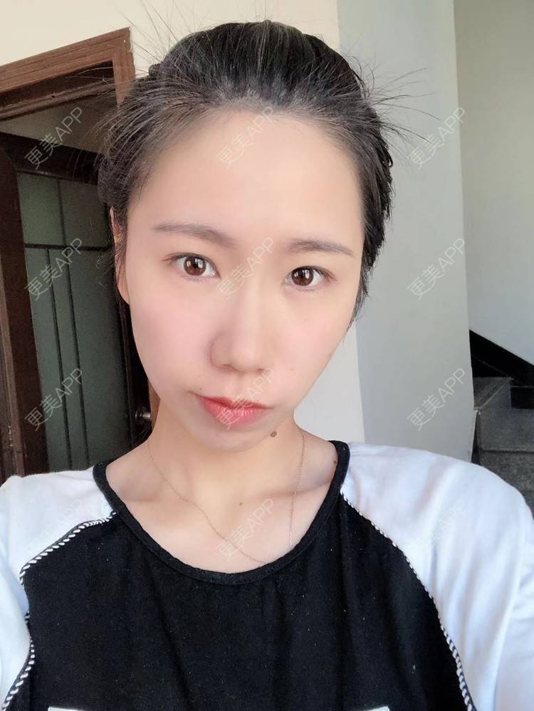 更美 - 更美用户IYey88gB48的硅胶丰太阳穴经验 | 硅胶丰太阳穴 | 膨体丰太阳穴 | 太阳穴 | 武汉