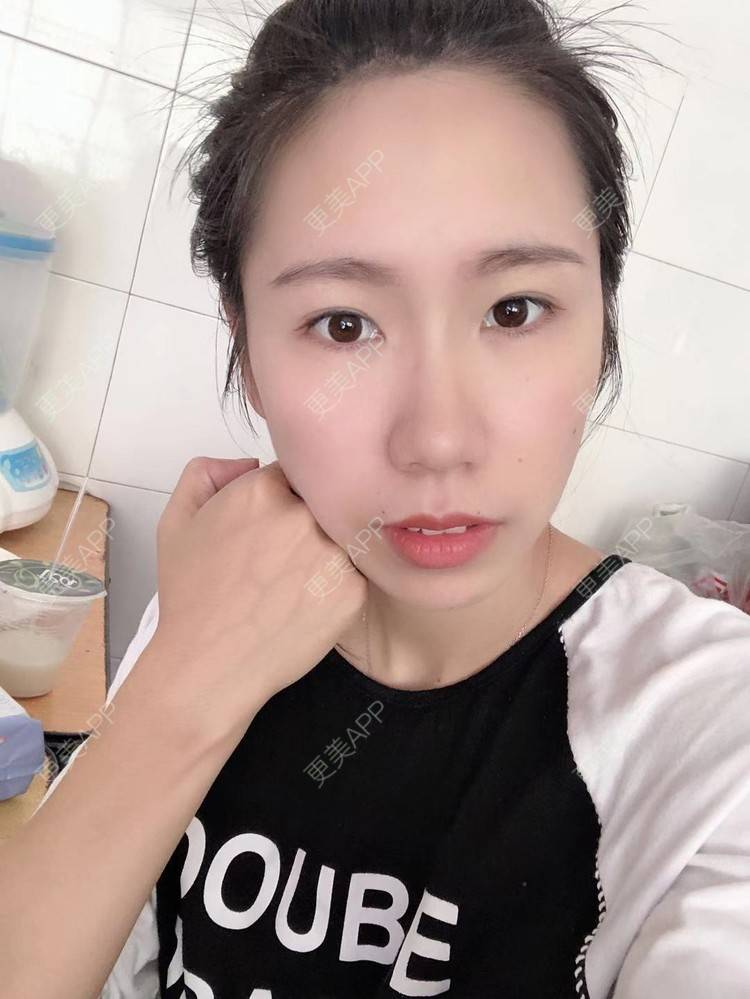 更美 - 更美用户IYey88gB48的硅胶丰太阳穴经验 | 硅胶丰太阳穴 | 膨体丰太阳穴 | 太阳穴 | 武汉