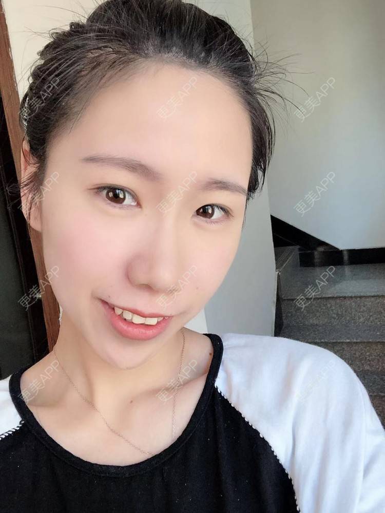 更美 - 更美用户IYey88gB48的硅胶丰太阳穴经验 | 硅胶丰太阳穴 | 膨体丰太阳穴 | 太阳穴 | 武汉