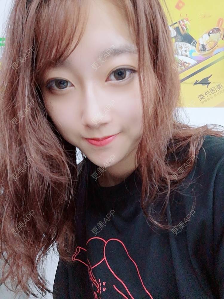 更美 - 更美用户3229022071的下颌角切除经验 | 广州 | 颧骨提高 | 下颌角切除