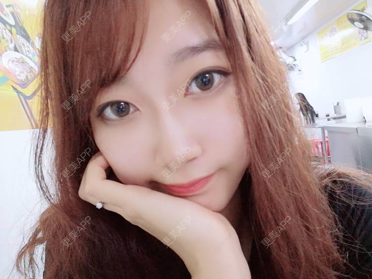 更美 - 更美用户3229022071的下颌角切除经验 | 广州 | 颧骨提高 | 下颌角切除