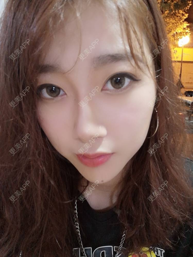 更美 - 更美用户3229022071的下颌角切除经验 | 广州 | 颧骨提高 | 下颌角切除