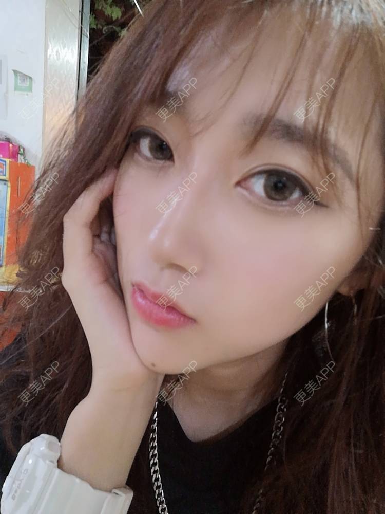 更美 - 更美用户3229022071的下颌角切除经验 | 广州 | 颧骨提高 | 下颌角切除