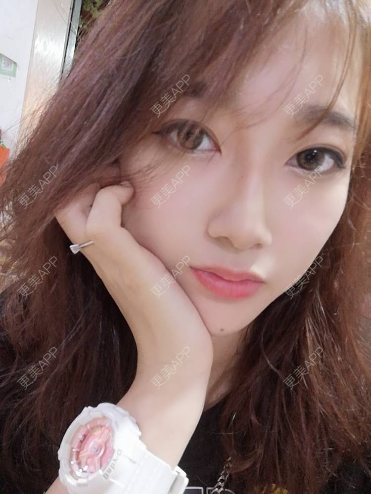 更美 - 更美用户3229022071的下颌角切除经验 | 广州 | 颧骨提高 | 下颌角切除