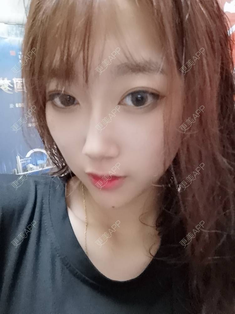 更美 - 更美用户3229022071的下颌角切除经验 | 广州 | 颧骨提高 | 下颌角切除