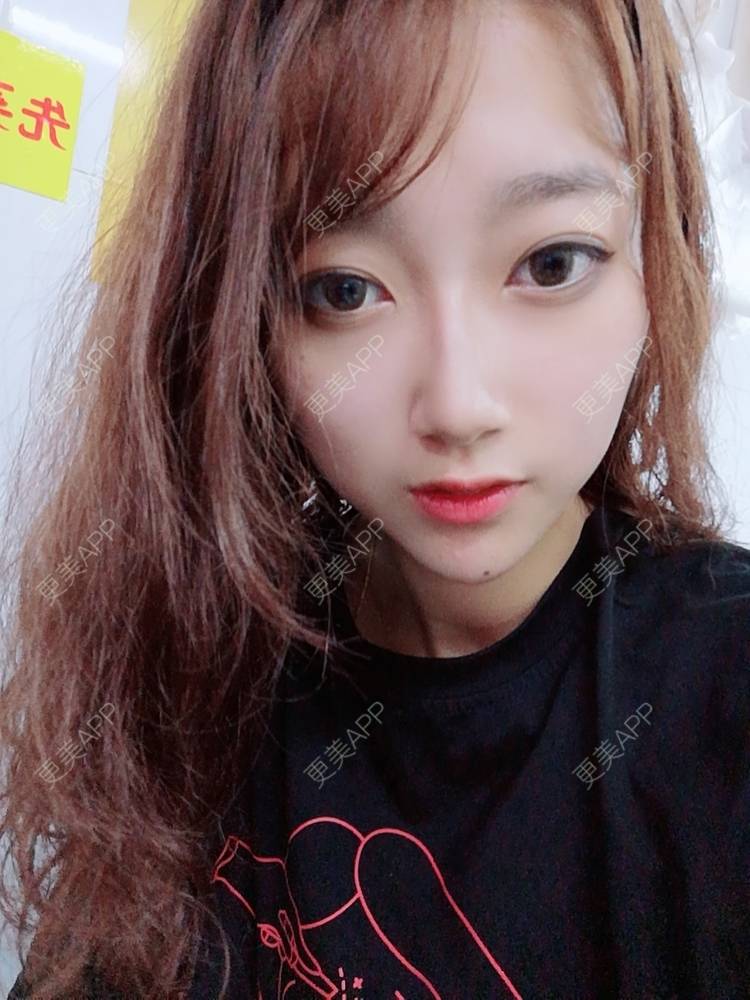 更美 - 更美用户3229022071的下颌角切除经验 | 广州 | 颧骨提高 | 下颌角切除