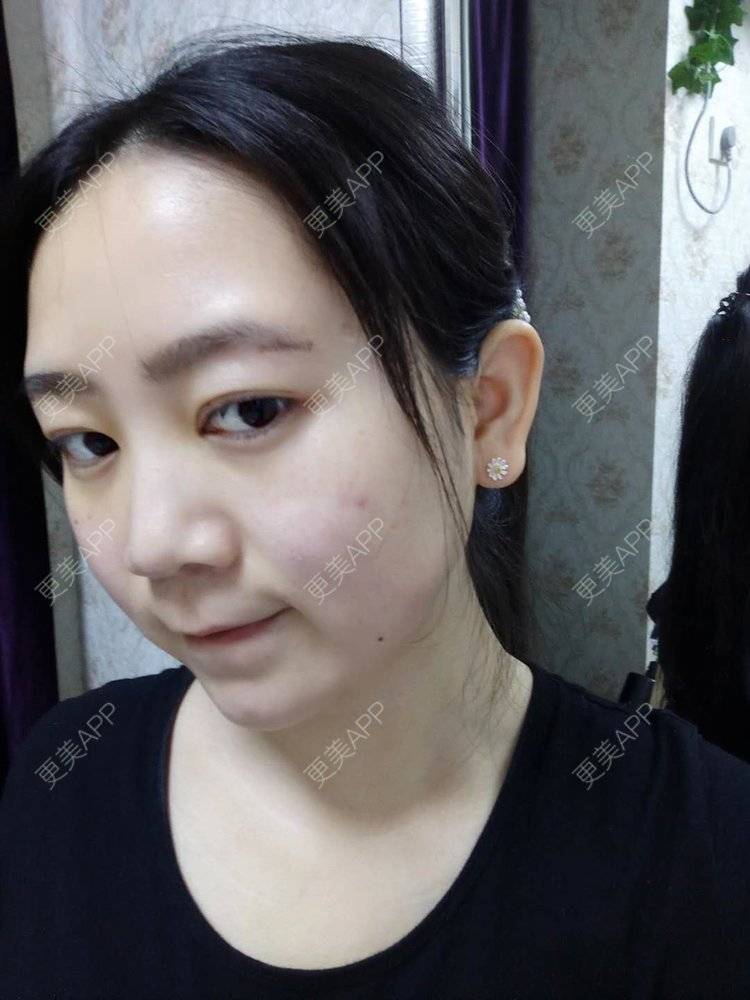 更美 - 更美用户HOXcRi8TmU的膨体垫眉弓经验 | 膨体垫眉弓