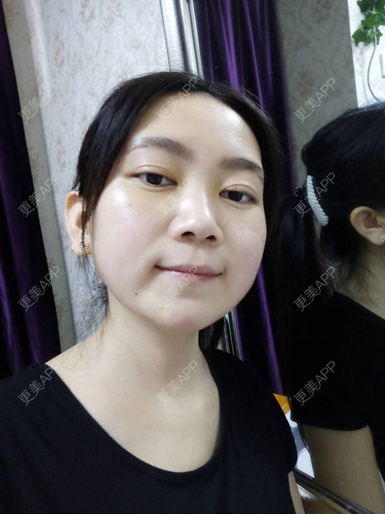 更美 - 更美用户HOXcRi8TmU的膨体垫眉弓经验 | 膨体垫眉弓