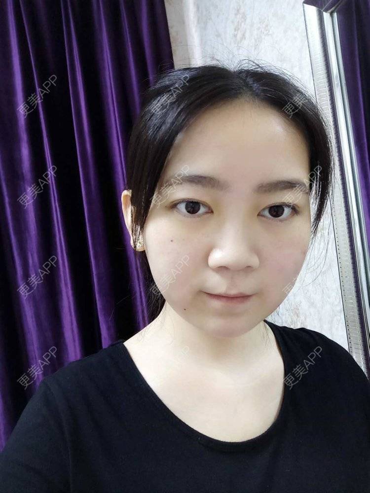 更美 - 更美用户HOXcRi8TmU的膨体垫眉弓经验 | 膨体垫眉弓