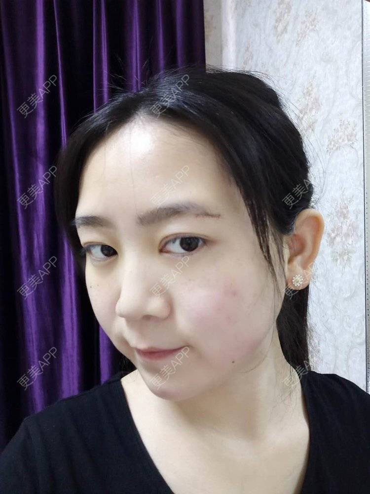 更美 - 更美用户HOXcRi8TmU的膨体垫眉弓经验 | 膨体垫眉弓