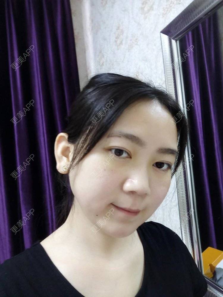 更美 - 更美用户HOXcRi8TmU的膨体垫眉弓经验 | 膨体垫眉弓